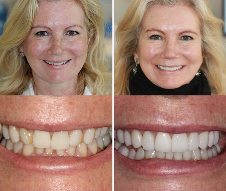 A complete smile makeover — before and after