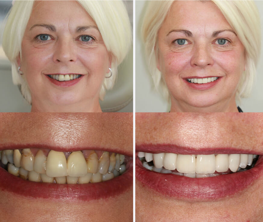Rebuilding worn, stained teeth — before and after