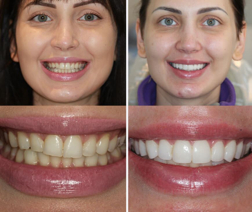 Brighter, balanced front teeth — before and after